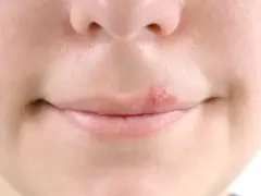 Zbliżenie na usta z widoczną opryszczką. Zmiana skórna na wardze górnej, typowa dla opryszczki u dzieci, wymaga uwagi.