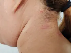 Czerwone plamy na karku mogą być objawem neuroboreliozy.