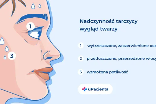 Objawy nadczynności tarczycy: wytrzeszczone oczy (1), przetłuszczone włosy (2) i wzmożona potliwość (3).