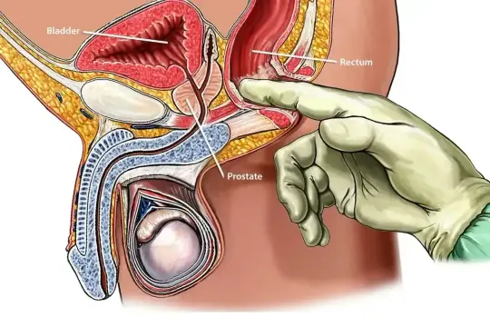 Ilustracja anatomiczna przedstawiająca badanie per rectum, kluczowe dla diagnostyki biopsji prostaty.