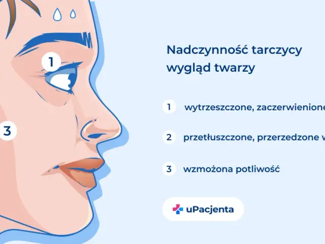 Objawy nadczynności tarczycy: wytrzeszczone oczy (1), przetłuszczone włosy (2) i wzmożona potliwość (3).